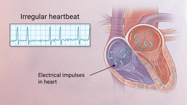 Afib