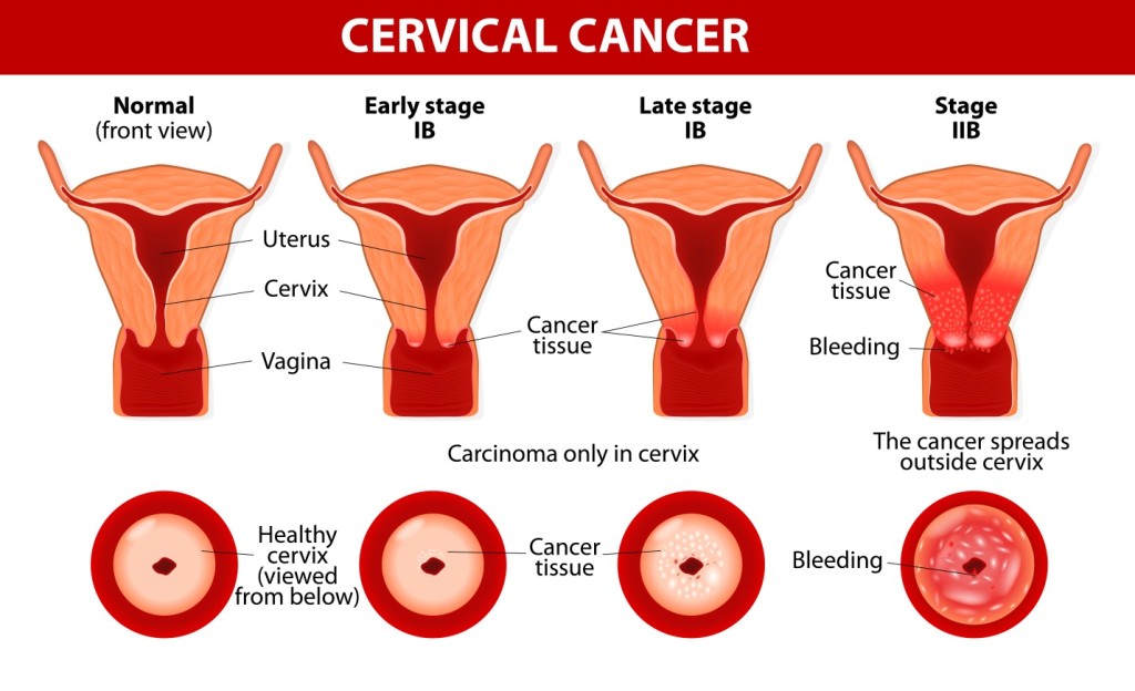 Cervical Cancer