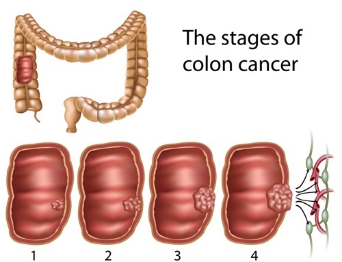 Colon Cancer