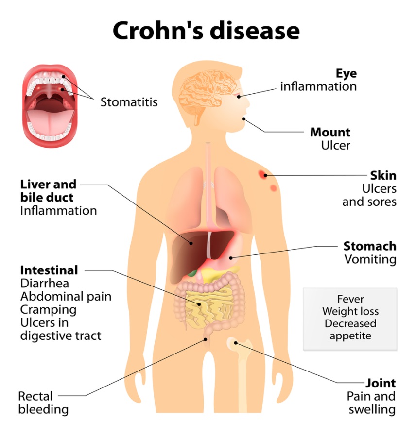 Crohns disease