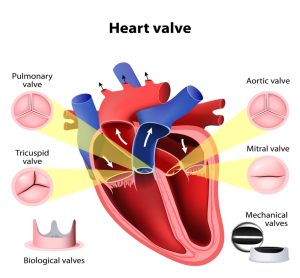 Mitral Valve Prolapse