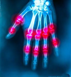 Rheumatoid Arthritis