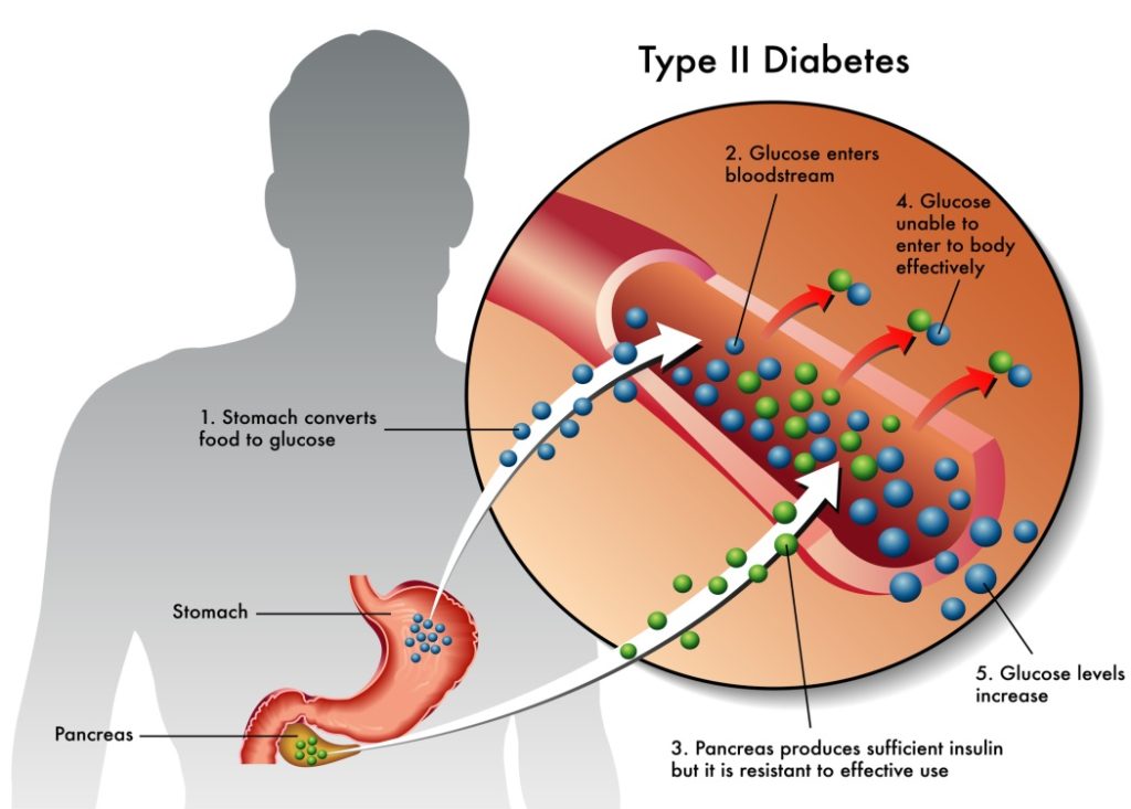 Type II Diabetes